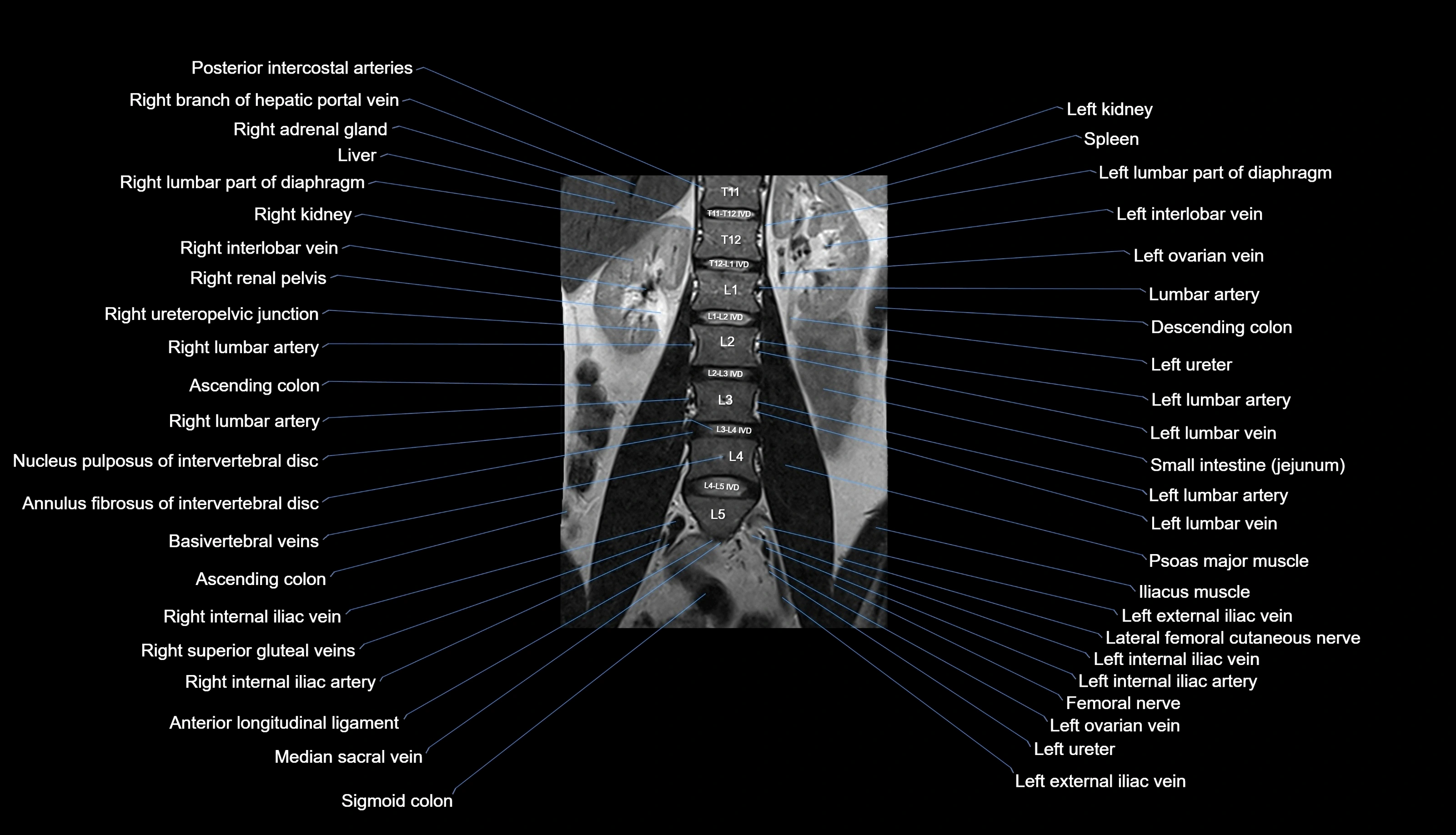 MRI lumbar spine labelled coronal cross sectional anatomy 3T radiology-img-00001-00013.webp